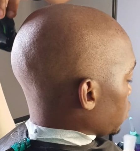 Client receiving a chiskop cut